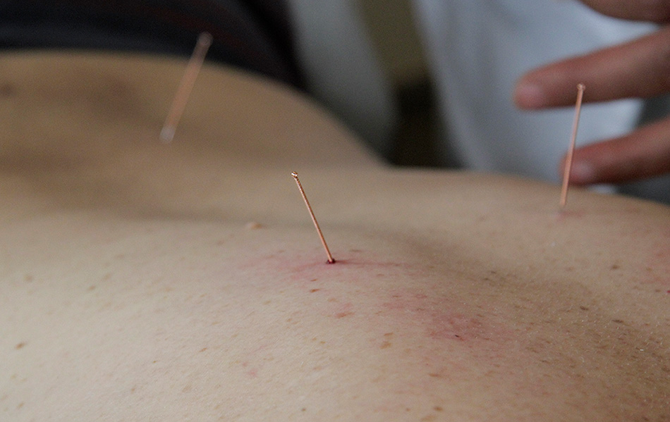 Klassische Akupunktur